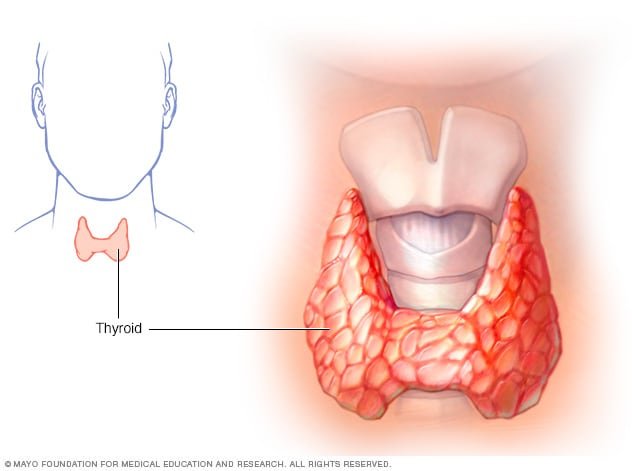 photo of Hyperthyroidism