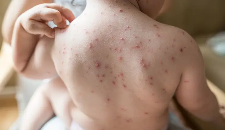 photo of Chickenpox