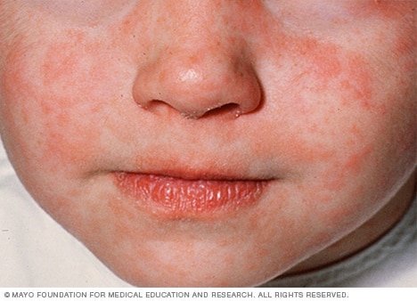 photo of measles disease