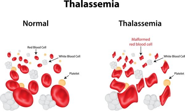 photo of thalassemia Disease