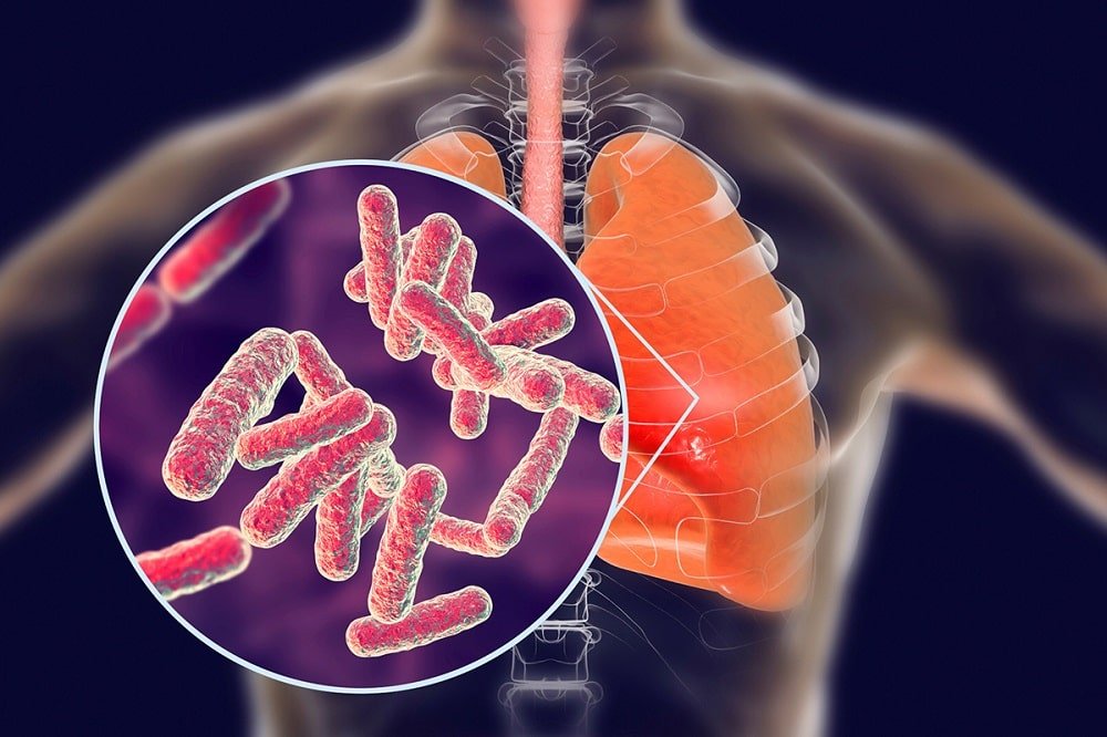 photo of tuberculosis